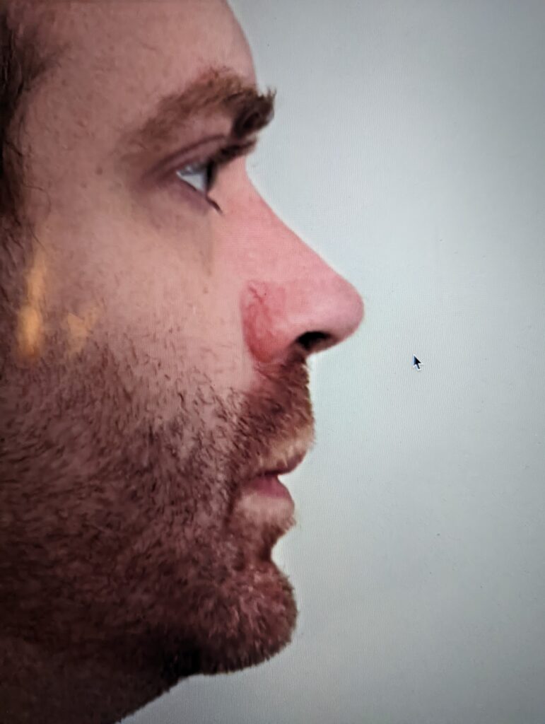 Side profile of a man with short brown facial hair, showing a red mark or scar on the side of his nose.